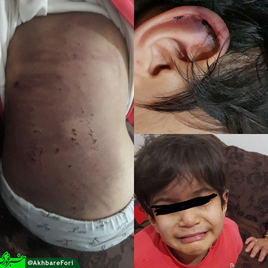کودک‌آزارى وحشتناک توسط نامادری در ارومیه