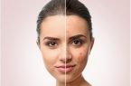 با این آنتی بیوتیک با آکنه و سکته خداحافظی کنید