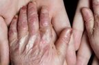 خدمات رایگان دندانپزشکی برای بیماران پروانه‌ای در تهران