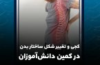 فیلم| انحراف و تغییر شکل ساختار بدن در کمین دانشآموزان فیلم| انحراف و تغییر شکل ساختار بدن در کمین دانشآموزان