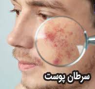 ۸ نکته طلایی برای پیشگیری از سرطان پوست