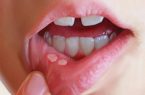 زخم‌های دهان؛ گذرا یا زنگ خطر؟