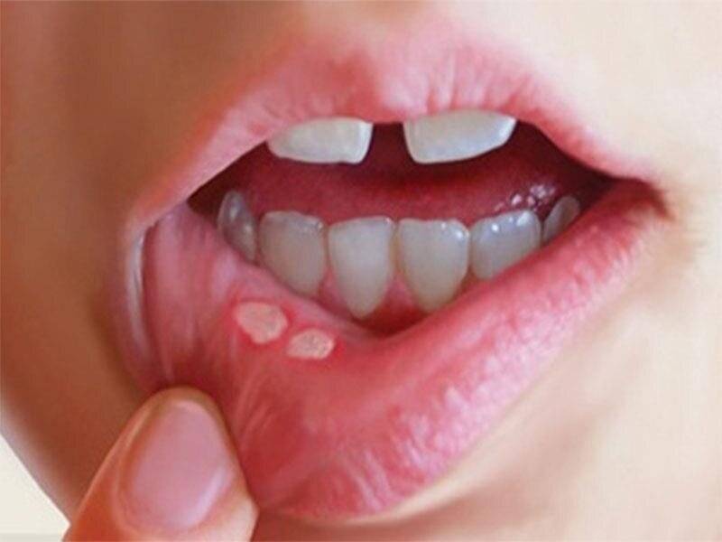 زخم‌های دهان؛ گذرا یا زنگ خطر؟